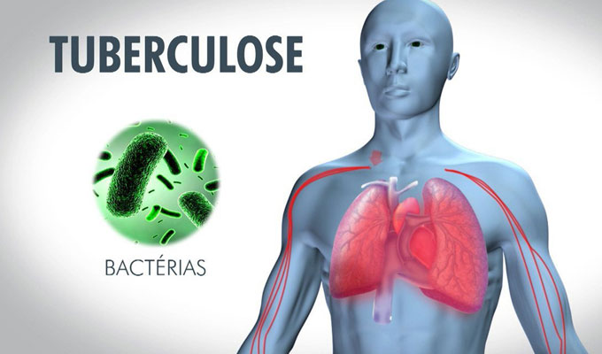 Lutte Contre La Tuberculose Le Sida Et Le Paludisme Loms Et Le Fonds Mondial Signent Un 