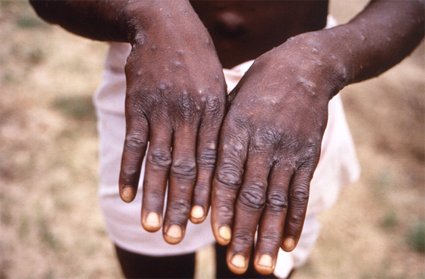 Pour intensifier la riposte face à l’épidémie de Mpox : Le Hcr à la recherche de près de 13 milliards de F Cfa